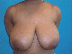 Patient before breast reduction procedure 